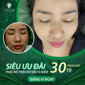 Siêu Ưu Đãi Phác Đồ Trị Sạch Nám 100% Siêu Vi Điểm – Trọn Gói 30tr Tại Nhung Spa