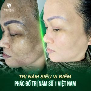 ĐIỀU TRỊ NÁM TRƯỚC KHI ” QUÁ MUỘN ” NHƯNG PHẢI ĐÚNG CHUẨN