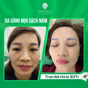 THANH XUÂN “THẮM LẠI” SAU LIỆU TRÌNH TRỊ NÁM SIÊU VI ĐIỂM TẠI NHUNG SPA