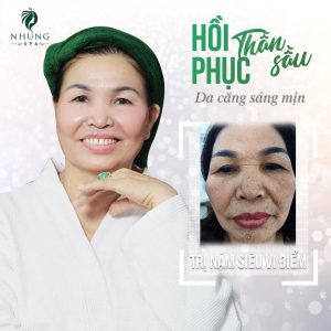 Hồi Phục Thần Sầu Da Căng Sáng Mịn Với Công Nghệ Trị Nám Siêu Vi Điểm Cao Cấp