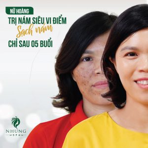 TRỊ NÁM CÔNG NGHỆ CAO ĐẸP TỰ TIN NHƯ KHÁCH NHÀ NHUNGSPA