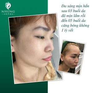 Feedback Khách Hàng Khi Trị Nám Tại Nhung Spa