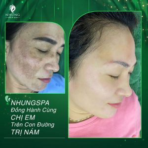 NÁM DA SAU SINH – NỖI LO MẤY AI THẤU?